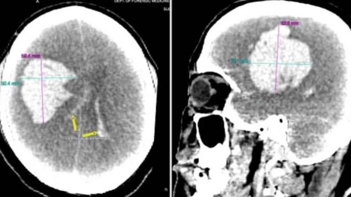 Alkollü olarak Viagra alan adam yaşamını kaybetti